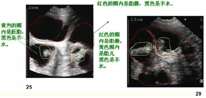 母豬妊娠25到40天B超圖像